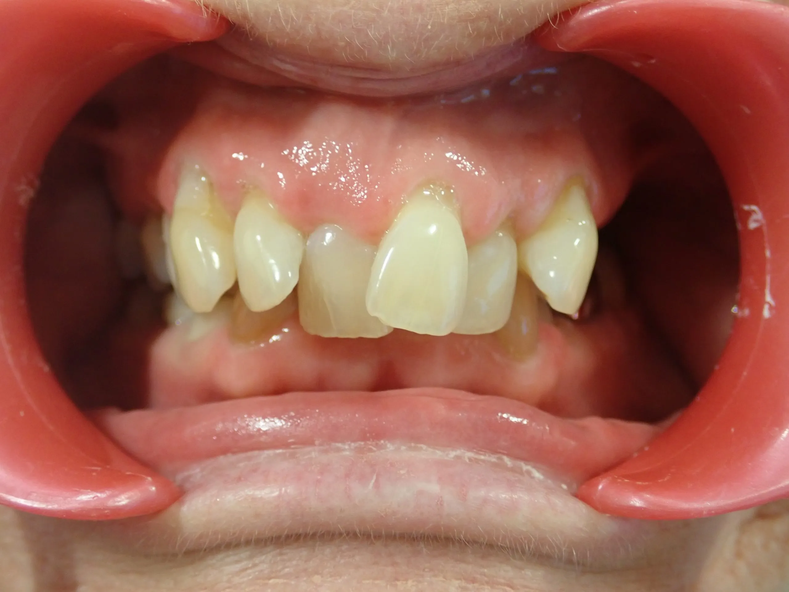Before orthodontic treatment — crowding correction Edinburgh