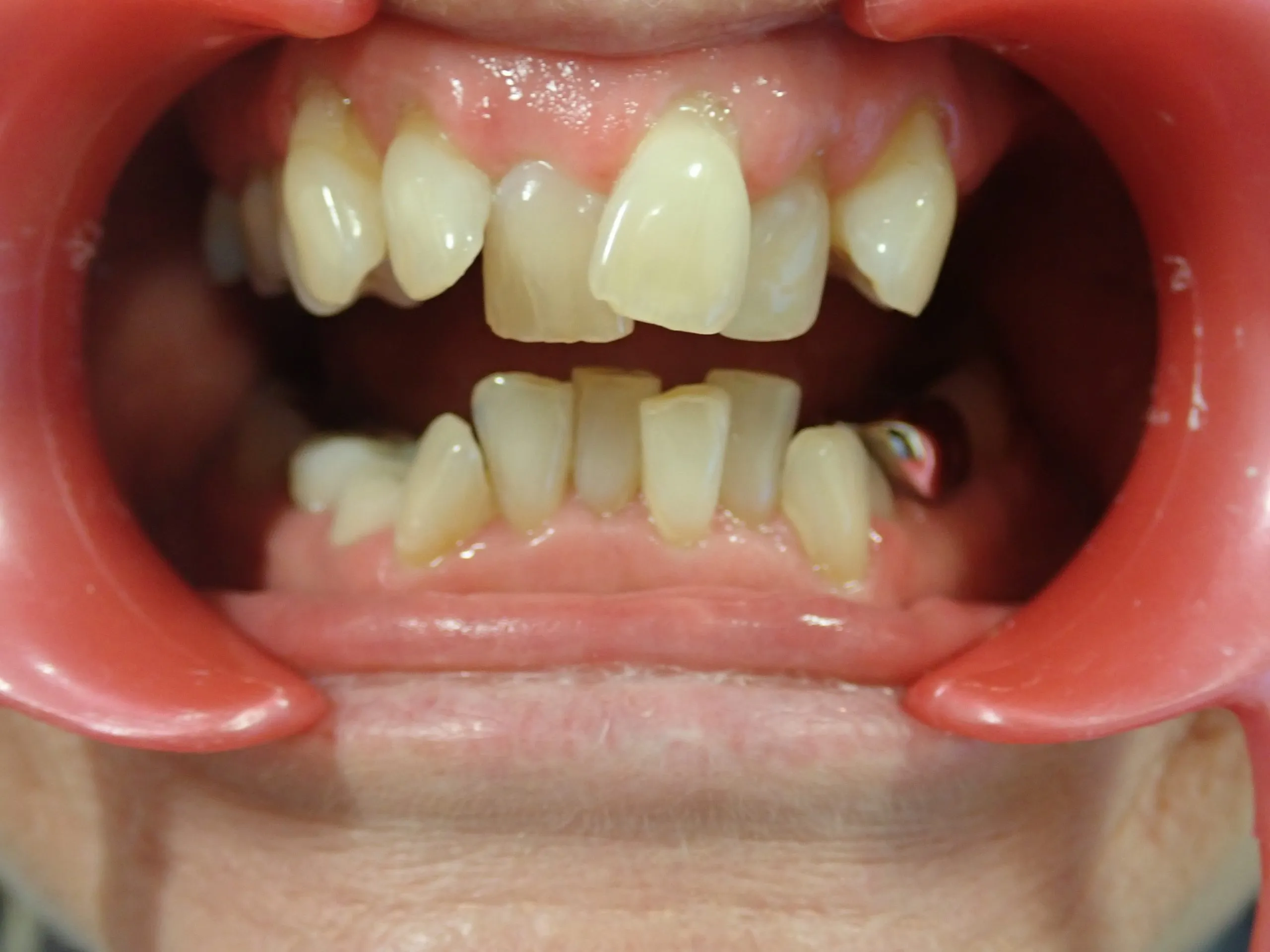 Before orthodontic treatment — side view Edinburgh