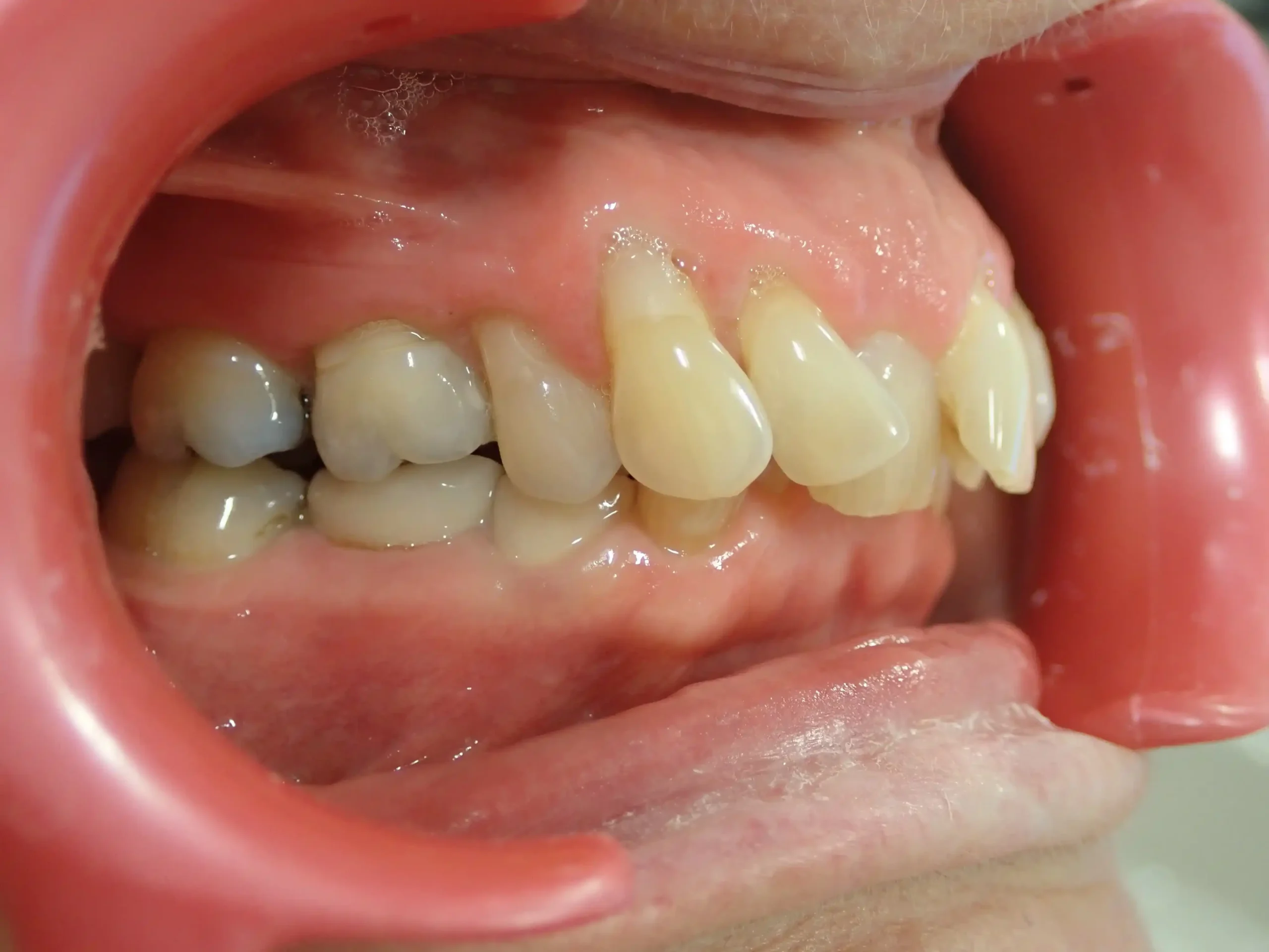 Before orthodontic treatment — upper arch Edinburgh