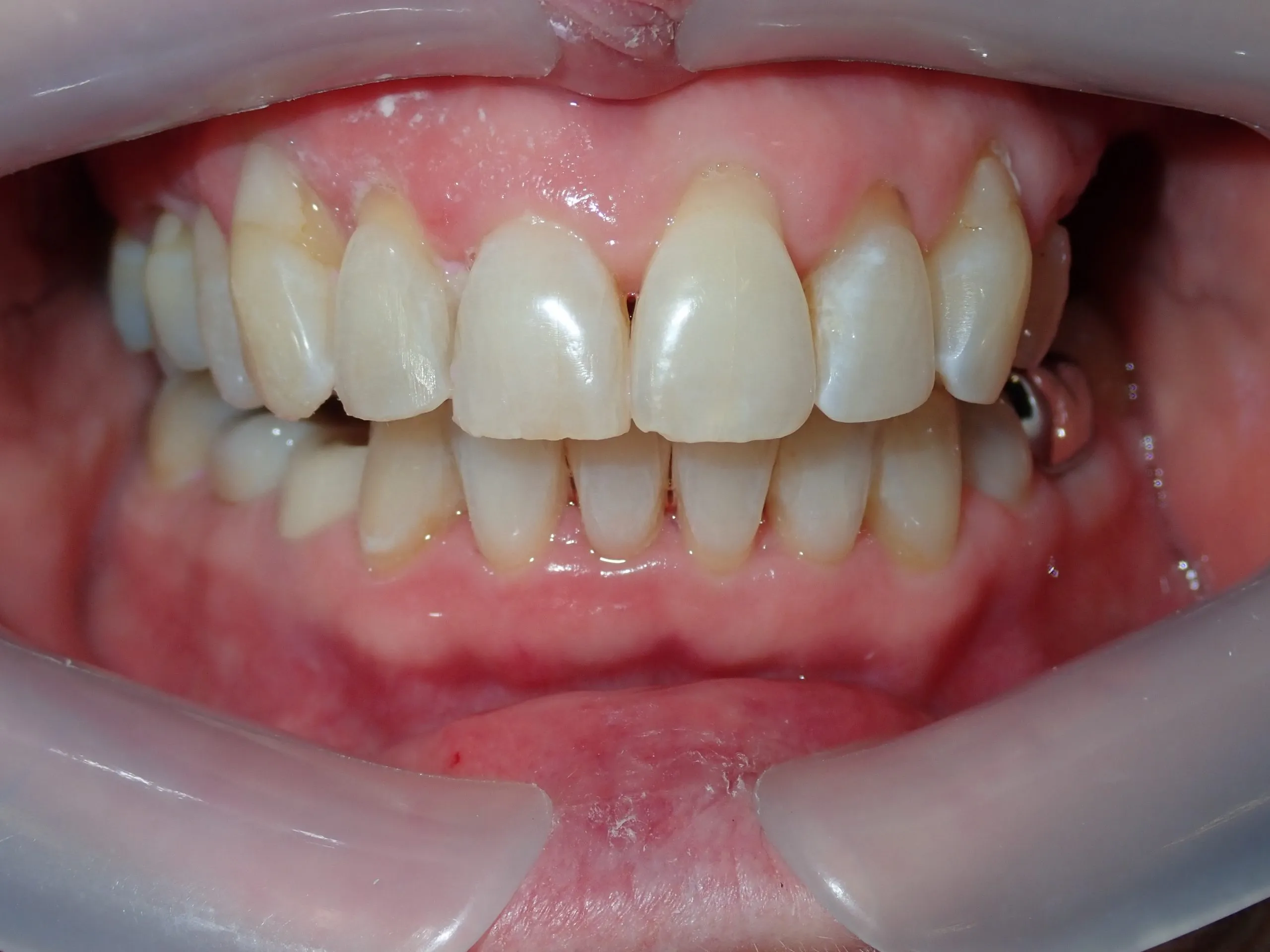After orthodontic treatment — crowding correction Edinburgh