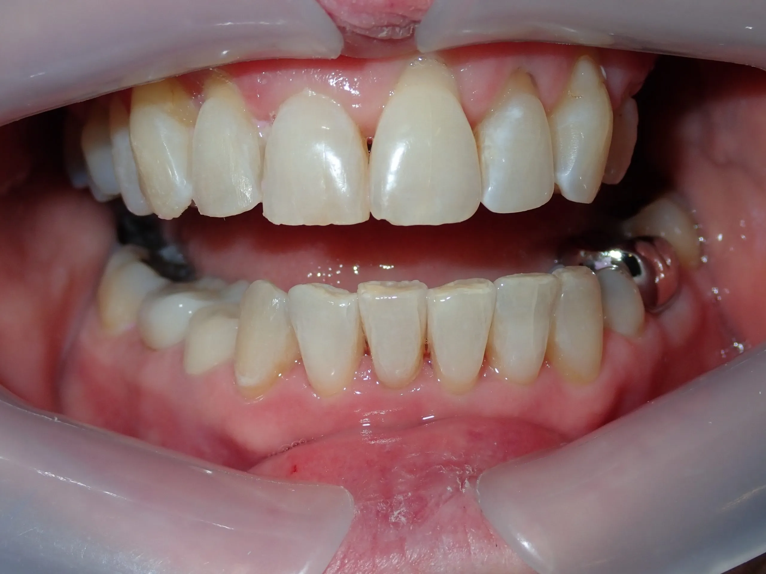 After orthodontic treatment — side view Edinburgh