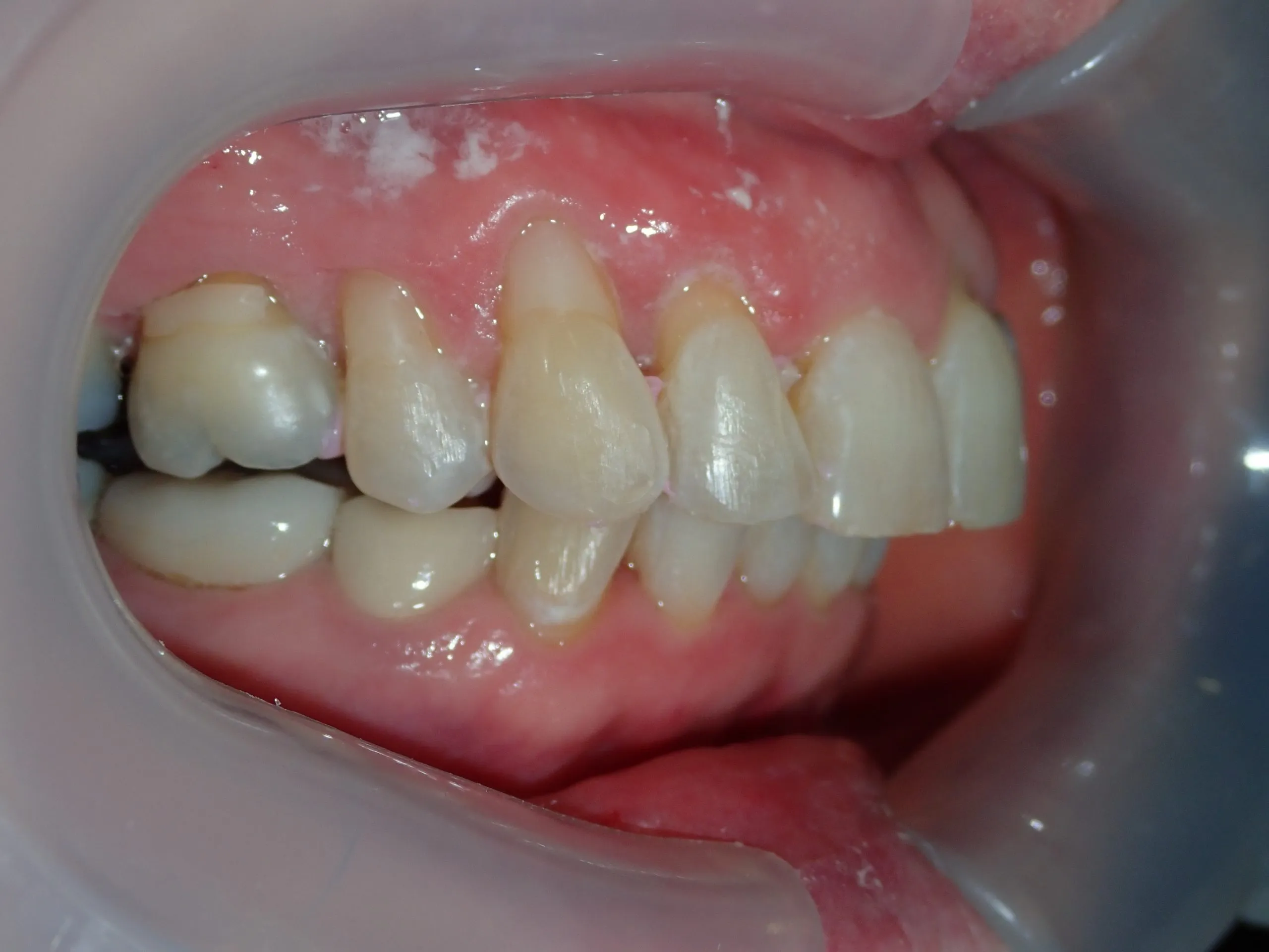 After orthodontic treatment — upper arch Edinburgh