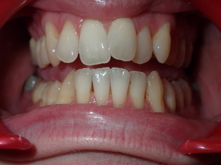 Before — protrusion correction case, Ocean Orthodontics Edinburgh