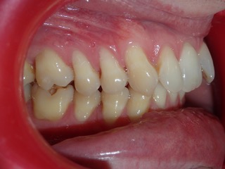 Before — side view protrusion case, Ocean Orthodontics Edinburgh