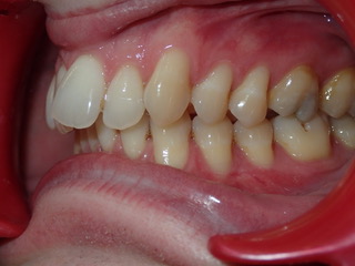 Before — occlusal protrusion case, Ocean Orthodontics Edinburgh