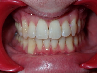 After — protrusion correction case, Ocean Orthodontics Edinburgh