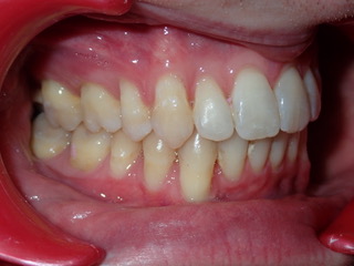 After — side view protrusion case, Ocean Orthodontics Edinburgh
