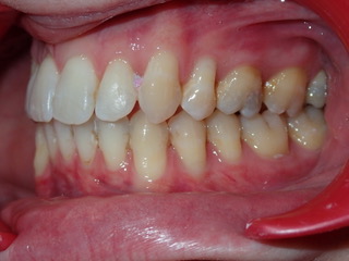 After — occlusal protrusion case, Ocean Orthodontics Edinburgh