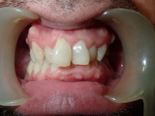 Before — upper arch view, Ocean Orthodontics Edinburgh