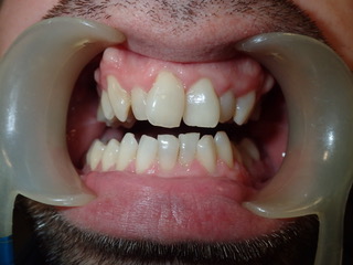 Before — arch expansion, Ocean Orthodontics Edinburgh