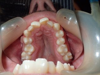 Before — side view arch expansion, Ocean Orthodontics Edinburgh