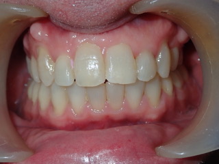 After — upper arch view, Ocean Orthodontics Edinburgh