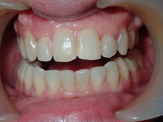 After — arch expansion, Ocean Orthodontics Edinburgh