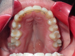 After — side view arch expansion, Ocean Orthodontics Edinburgh