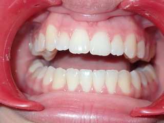 After — narrow arch correction, Ocean Orthodontics Edinburgh