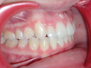 After — side view canine case, Ocean Orthodontics Edinburgh