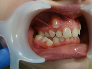 Before — arch view canine case, Ocean Orthodontics Edinburgh