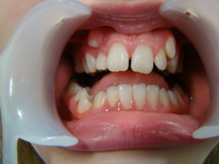 Before — narrow arch correction, Ocean Orthodontics Edinburgh