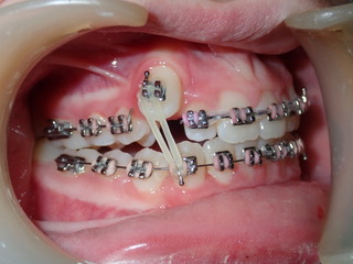 After — arch view canine case, Ocean Orthodontics Edinburgh