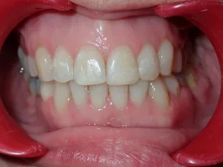 After Class III jaw correction — Ocean Orthodontics Edinburgh