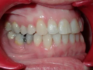 After jaw correction — side view Edinburgh