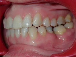 After jaw correction — occlusal view Edinburgh