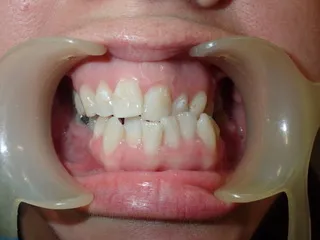 Before Class III jaw correction — Ocean Orthodontics Edinburgh