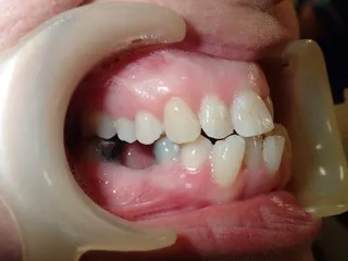 Before jaw correction — side view Edinburgh