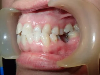 Before jaw correction — occlusal view Edinburgh