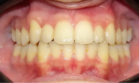 Front view after treatment at Ocean Orthodontics, showing an evenly aligned smile.