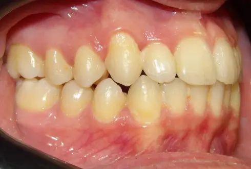 Side view after treatment, showing reduced overjet and well-aligned teeth.