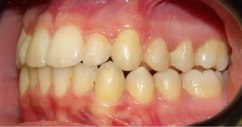 Side view after treatment, showing improved bite and proper tooth alignment.