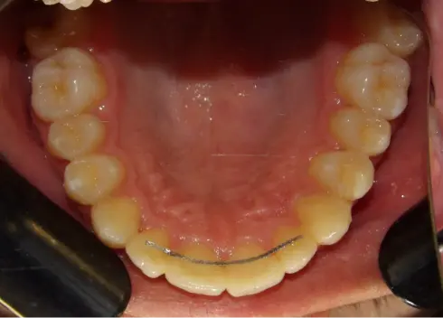 Top-down view of the lower teeth after treatment at Ocean Orthodontics, with retainer fitted.
