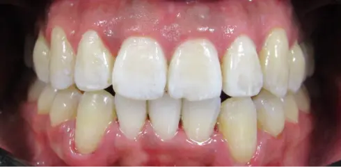 Front view after treatment at Ocean Orthodontics, showing an evenly aligned smile.