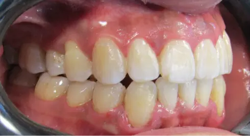 Side view after treatment, showing well-aligned teeth and a corrected bite.