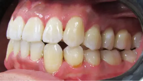 Side view after treatment, showing improved alignment and arch shape.
