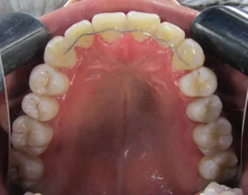Top-down view of the upper teeth after treatment at Ocean Orthodontics, with retainer fitted.