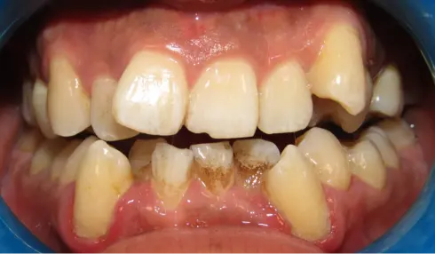 Front view before treatment, showing severe crowding and crossbite.