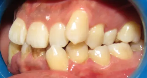Side view before treatment, with crowding visible from the opposite side.