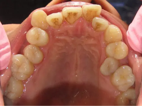 Top-down view of the upper teeth before treatment, showing crowding and a narrow arch.