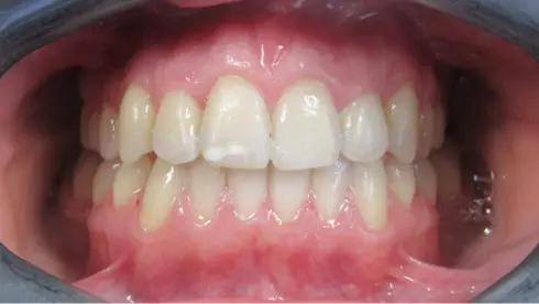 Front view after treatment, showing a wider arch and evenly aligned smile.