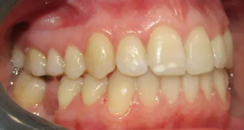 Side view after treatment at Ocean Orthodontics, showing corrected bite and aligned teeth.