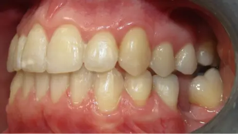Side view after treatment, showing the corrected bite and proper tooth alignment.