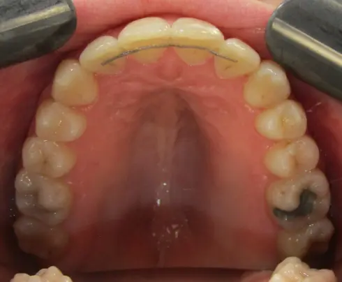 Top-down view of the upper teeth after expansion at Ocean Orthodontics, with retainer fitted.