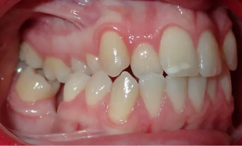 Side view before treatment, showing crossbite and crowding in the upper and lower teeth.