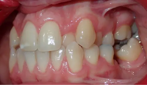 Side view before treatment, with crossbite visible from the opposite side.