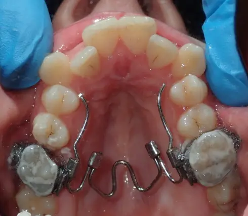 Top-down view of the upper teeth with the palatal expander fitted to widen the arch.