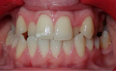 Front view before treatment, showing the narrow upper jaw and misaligned teeth.