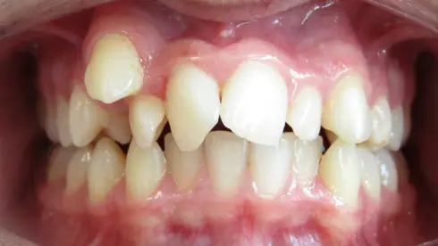 Front view before treatment, showing severe crowding in the upper and lower teeth.