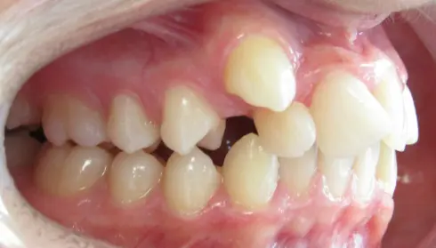 Side view before treatment, showing severe overjet and crowding in a teenage patient.